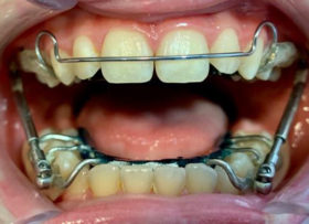 pul dentaire orthodontie